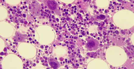 Inequidades no tratamento de síndromes mielodisplásicas identificadas